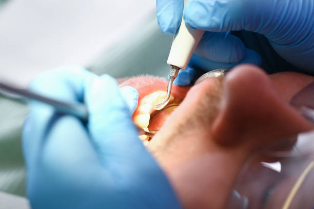 Best Broken or Chipped Tooth Repair in Fredericksburg, IA