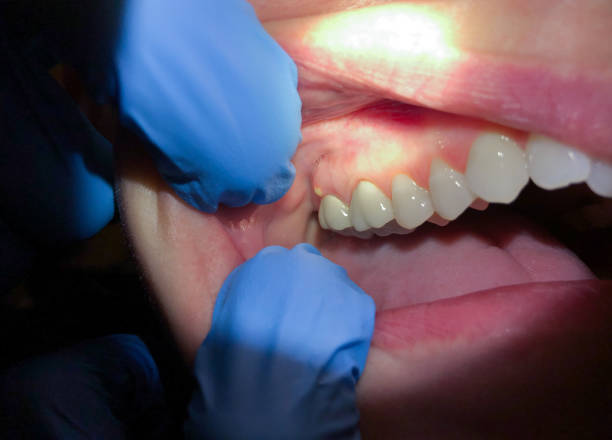 Best Emergency Treatment for Oral Infections in Fredericksburg, IA